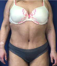 Tummy Tuck After Photo by Mark Markarian, MD, MSPH, FACS; Wellesley, MA - Case 38059