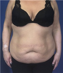 Tummy Tuck Before Photo by Mark Markarian, MD, MSPH, FACS; Wellesley, MA - Case 38059