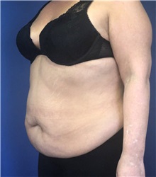 Tummy Tuck Before Photo by Mark Markarian, MD, MSPH, FACS; Wellesley, MA - Case 38059