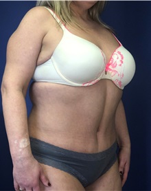Tummy Tuck After Photo by Mark Markarian, MD, MSPH, FACS; Wellesley, MA - Case 38059