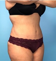 Tummy Tuck After Photo by Mark Markarian, MD, MSPH, FACS; Wellesley, MA - Case 38060