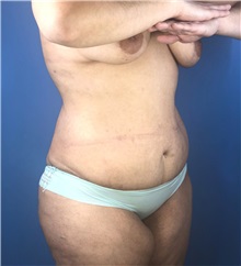 Tummy Tuck Before Photo by Mark Markarian, MD, MSPH, FACS; Wellesley, MA - Case 38060