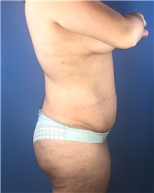 Tummy Tuck Before Photo by Mark Markarian, MD, MSPH, FACS; Wellesley, MA - Case 38060