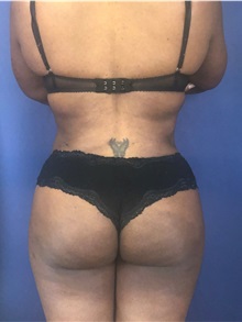 Buttock Lift with Augmentation After Photo by Mark Markarian, MD, MSPH, FACS; Wellesley, MA - Case 38063