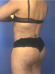 Buttock Lift with Augmentation After Photo by Mark Markarian, MD, MSPH, FACS; Wellesley, MA - Case 38063