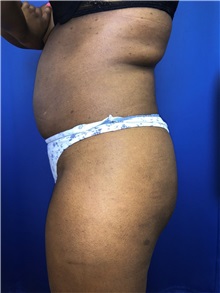 Buttock Lift with Augmentation Before Photo by Mark Markarian, MD, MSPH, FACS; Wellesley, MA - Case 38063