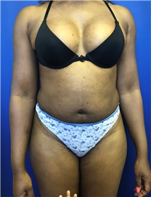 Liposuction Before Photo by Mark Markarian, MD, MSPH, FACS; Wellesley, MA - Case 38064