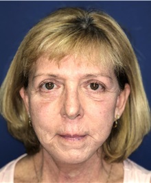 Eyelid Surgery After Photo by Mark Markarian, MD, MSPH, FACS; Wellesley, MA - Case 38065