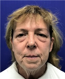 Eyelid Surgery Before Photo by Mark Markarian, MD, MSPH, FACS; Wellesley, MA - Case 38065