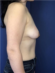 Breast Lift Before Photo by Mark Markarian, MD, MSPH, FACS; Wellesley, MA - Case 38067