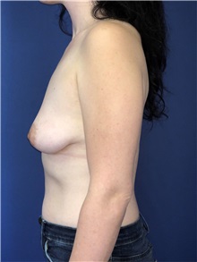 Breast Lift Before Photo by Mark Markarian, MD, MSPH, FACS; Wellesley, MA - Case 38067