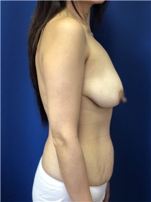 Breast Lift Before Photo by Mark Markarian, MD, MSPH, FACS; Wellesley, MA - Case 38068