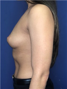 Breast Augmentation Before Photo by Mark Markarian, MD, MSPH, FACS; Wellesley, MA - Case 38083