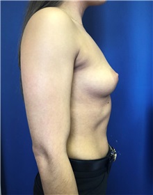 Breast Augmentation Before Photo by Mark Markarian, MD, MSPH, FACS; Wellesley, MA - Case 38083