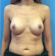 Breast Augmentation After Photo by Mark Markarian, MD, MSPH, FACS; Wellesley, MA - Case 38084