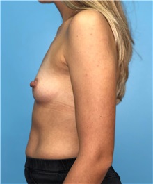 Breast Augmentation Before Photo by Mark Markarian, MD, MSPH, FACS; Wellesley, MA - Case 38084