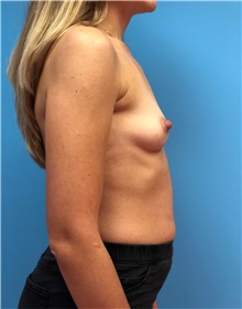 Breast Augmentation Before Photo by Mark Markarian, MD, MSPH, FACS; Wellesley, MA - Case 38084