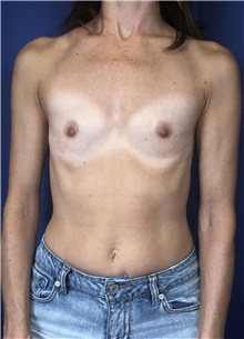 Breast Augmentation Before Photo by Mark Markarian, MD, MSPH, FACS; Wellesley, MA - Case 38088