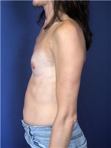 Breast Augmentation Before Photo by Mark Markarian, MD, MSPH, FACS; Wellesley, MA - Case 38088