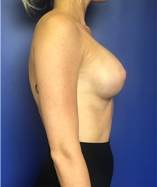 Breast Augmentation After Photo by Mark Markarian, MD, MSPH, FACS; Wellesley, MA - Case 38123