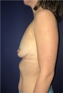 Breast Augmentation Before Photo by Mark Markarian, MD, MSPH, FACS; Wellesley, MA - Case 38146