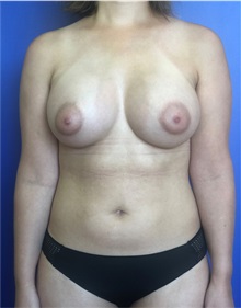 Breast Augmentation After Photo by Mark Markarian, MD, MSPH, FACS; Wellesley, MA - Case 38147