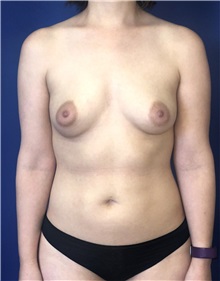 Breast Augmentation Before Photo by Mark Markarian, MD, MSPH, FACS; Wellesley, MA - Case 38147