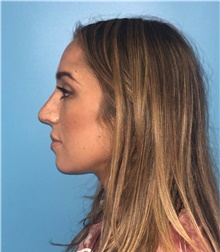 Rhinoplasty After Photo by Mark Markarian, MD, MSPH, FACS; Wellesley, MA - Case 42531