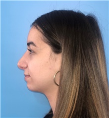 Rhinoplasty After Photo by Mark Markarian, MD, MSPH, FACS; Wellesley, MA - Case 42532