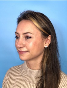 Rhinoplasty After Photo by Mark Markarian, MD, MSPH, FACS; Wellesley, MA - Case 42533