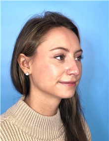 Rhinoplasty After Photo by Mark Markarian, MD, MSPH, FACS; Wellesley, MA - Case 42533