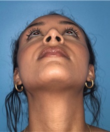 Rhinoplasty After Photo by Mark Markarian, MD, MSPH, FACS; Wellesley, MA - Case 42534