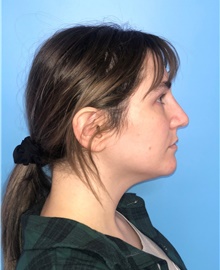 Rhinoplasty After Photo by Mark Markarian, MD, MSPH, FACS; Wellesley, MA - Case 42535