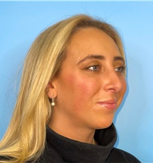Rhinoplasty After Photo by Mark Markarian, MD, MSPH, FACS; Wellesley, MA - Case 42536