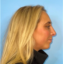 Rhinoplasty After Photo by Mark Markarian, MD, MSPH, FACS; Wellesley, MA - Case 42536