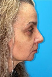 Rhinoplasty After Photo by Mark Markarian, MD, MSPH, FACS; Wellesley, MA - Case 42538