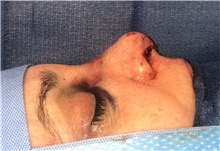 Rhinoplasty After Photo by Mark Markarian, MD, MSPH, FACS; Wellesley, MA - Case 42538