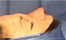 Rhinoplasty After Photo by Mark Markarian, MD, MSPH, FACS; Wellesley, MA - Case 42539