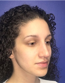 Rhinoplasty After Photo by Mark Markarian, MD, MSPH, FACS; Wellesley, MA - Case 42540