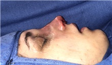 Rhinoplasty After Photo by Mark Markarian, MD, MSPH, FACS; Wellesley, MA - Case 42541