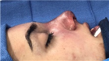 Rhinoplasty After Photo by Mark Markarian, MD, MSPH, FACS; Wellesley, MA - Case 42600