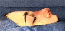 Rhinoplasty After Photo by Mark Markarian, MD, MSPH, FACS; Wellesley, MA - Case 42601