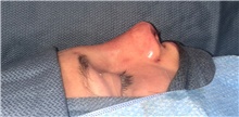 Rhinoplasty After Photo by Mark Markarian, MD, MSPH, FACS; Wellesley, MA - Case 42605