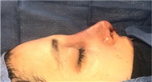 Rhinoplasty After Photo by Mark Markarian, MD, MSPH, FACS; Wellesley, MA - Case 42608