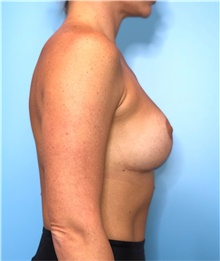 Breast Lift After Photo by Mark Markarian, MD, MSPH, FACS; Wellesley, MA - Case 42610