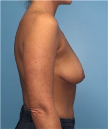 Breast Lift Before Photo by Mark Markarian, MD, MSPH, FACS; Wellesley, MA - Case 42610