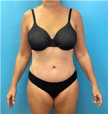 Tummy Tuck After Photo by Mark Markarian, MD, MSPH, FACS; Wellesley, MA - Case 47326