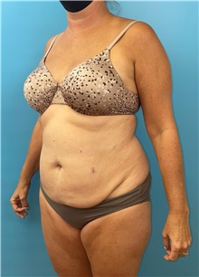 Tummy Tuck Before Photo by Mark Markarian, MD, MSPH, FACS; Wellesley, MA - Case 47326