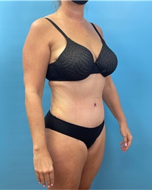 Tummy Tuck After Photo by Mark Markarian, MD, MSPH, FACS; Wellesley, MA - Case 47326