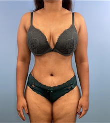 Tummy Tuck After Photo by Mark Markarian, MD, MSPH, FACS; Wellesley, MA - Case 47914